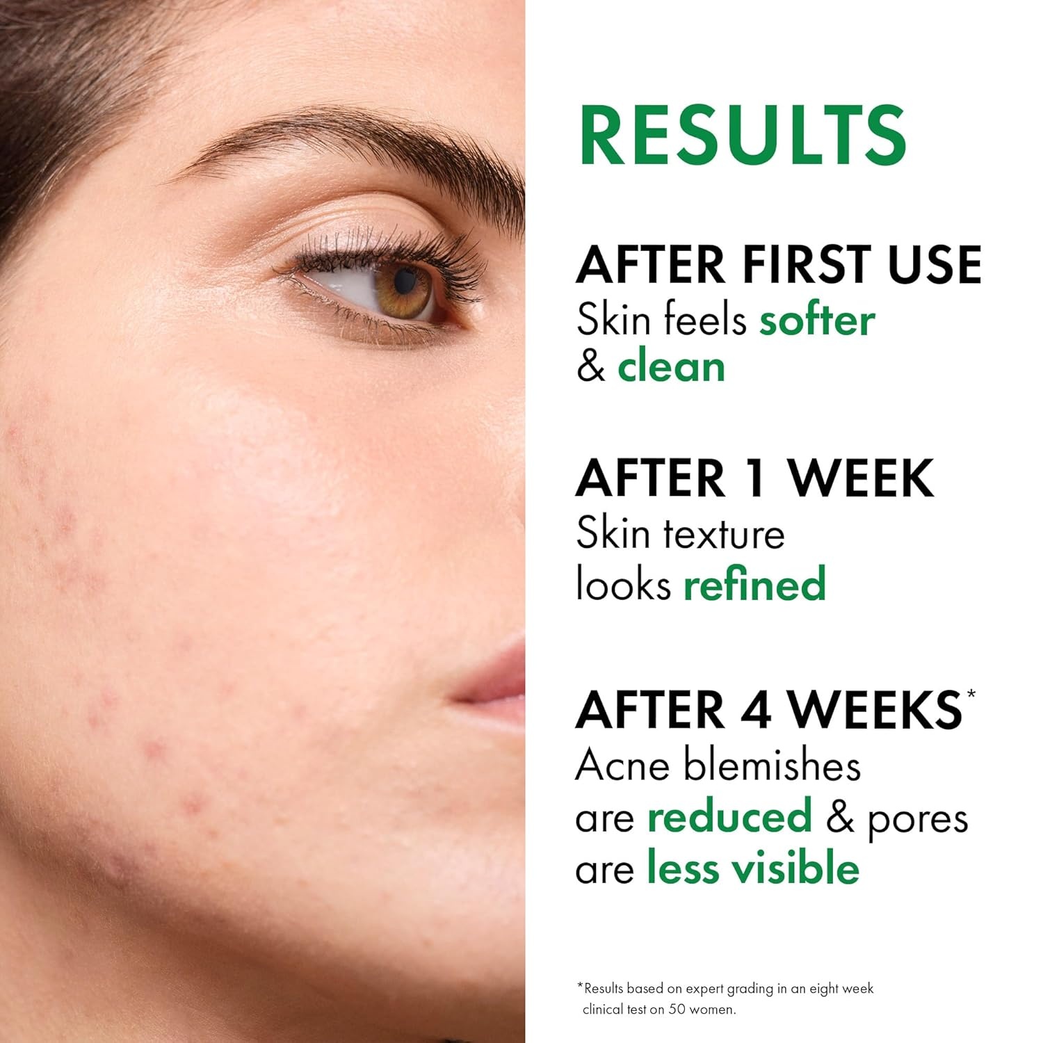 image:imageVICHY Normaderm Acne Control Daily Moisturizer Oil Free Acne Moisturizer For Face Max Strength 2 Salicylic Acid Hyaluronic Acid Vitamin C Targets Blackheads Blemishes amp Enlarged Pores17 Fl Oz Pack of 1