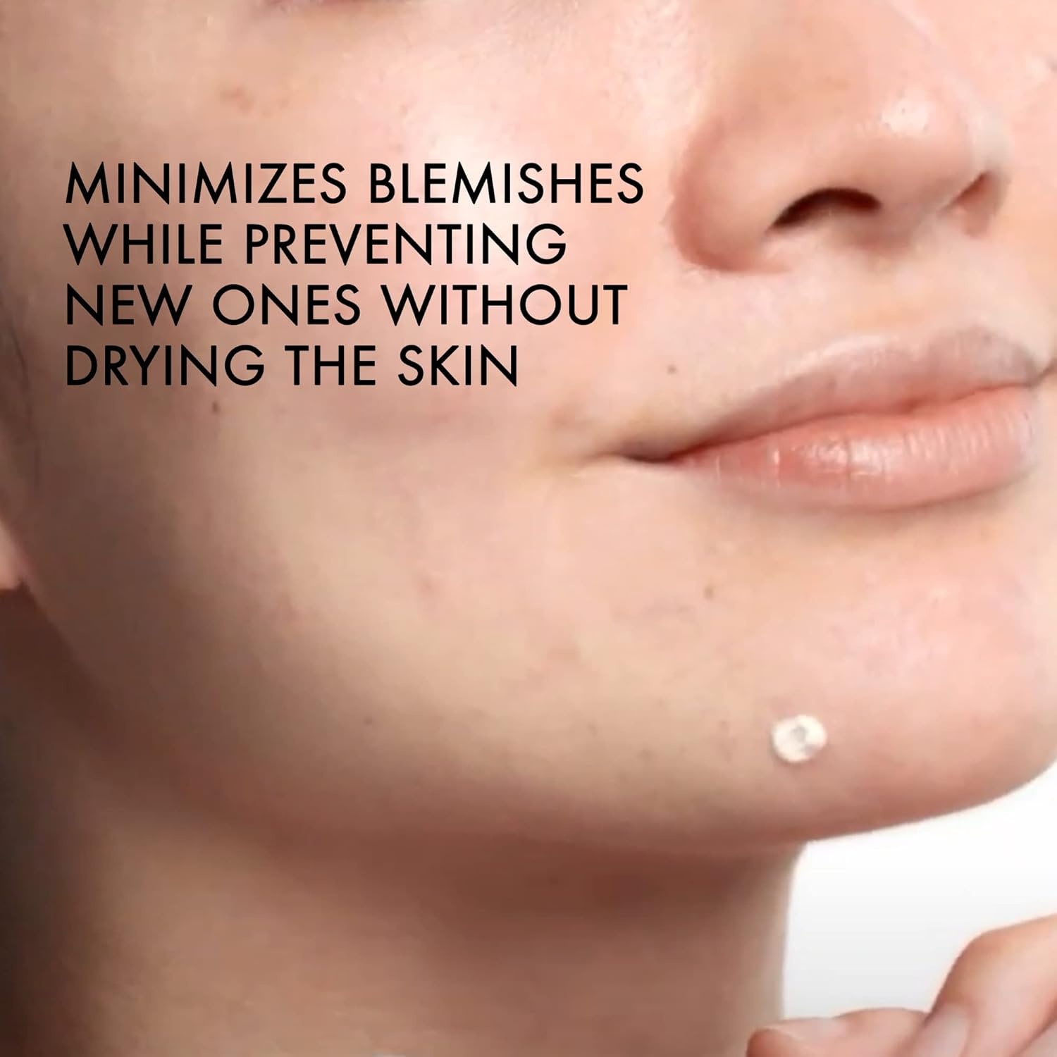 image:imageVichy Normaderm SOS Acne Rescue Spot Corrector Acne Spot Treatment for Face with 10 Sulfur Niacinamide amp Glycolic Acid Suitable for Sensitive Skin